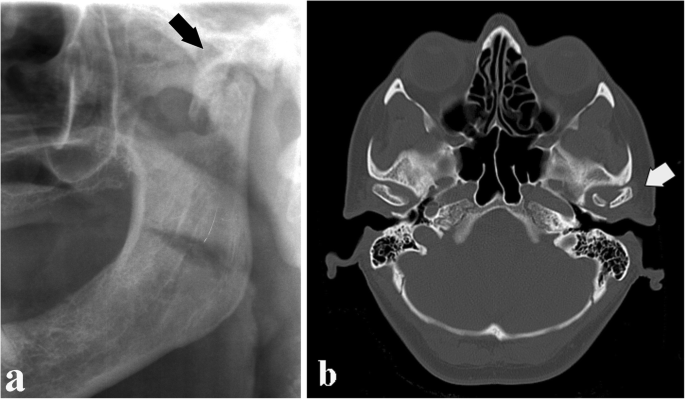 CT scan showing mandibular and facial bone fractures from trauma