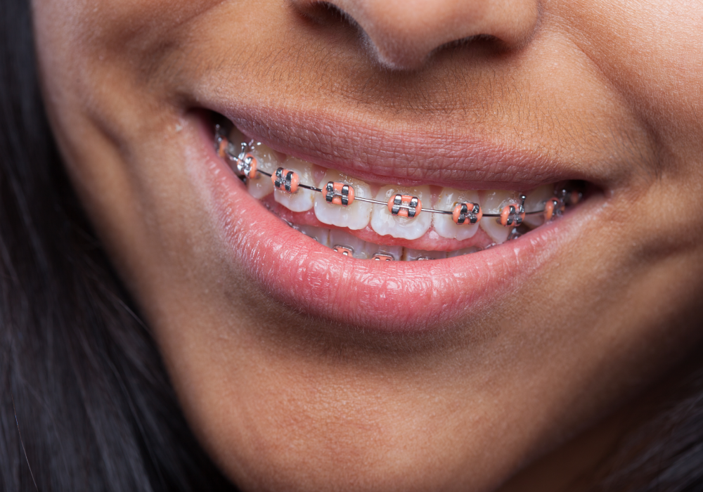 Clear aligners trays for orthodontic treatment