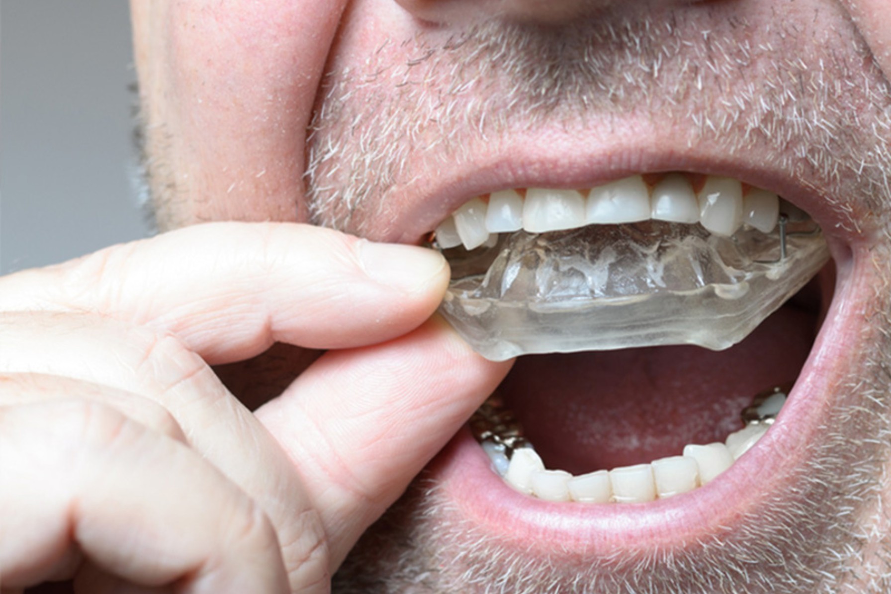 Patient comfortably wearing a custom night guard during sleep