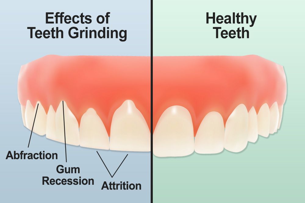 Damaged teeth from bruxism - wear, cracks, and fractures