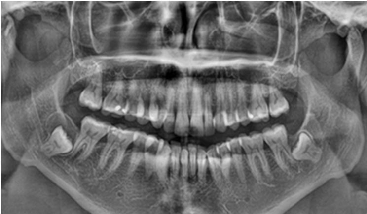 Panoramic dental X-ray showing a large jaw cyst associated with an unerupted tooth